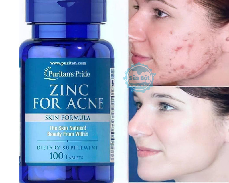 Viên kẽm ngừa mụn Puritan's Pride Zinc For Acne dùng mỗi ngày 2 viên 