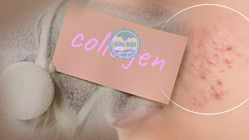 Da mụn có uống được collagen không? Câu trả lời là có, collagen hỗ trợ điều trị, giảm thâm mụn hiệu quả