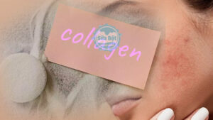Da mụn có uống được collagen không?