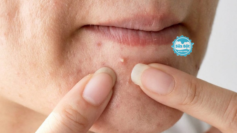 Bật mí cách nặn mụn không bị thâm tại nhà cực an toàn