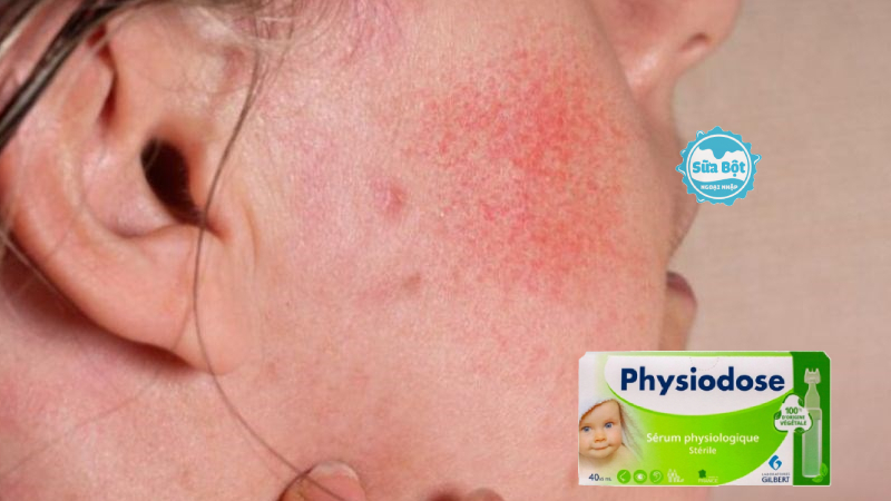 Cách trị dị ứng da mặt bằng nước muối hiệu quả tại nhà
